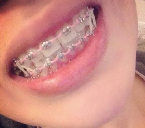 Braces Power Chain Braces, Braces Colors Combinations, Pink Braces, Braces Retainer, Teeth Aesthetic, Cute Braces Colors, Pretty Teeth, Adult Braces, Braces Tips