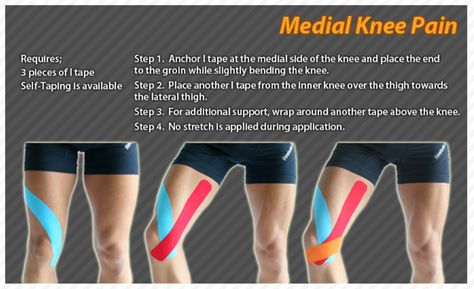 Kinesiology taping instructions for medial knee pain #ktape #ares #knee #pain Facitis Plantar, Medial Knee Pain, Soccer Injuries, Knee Taping, Sport Injuries, Knee Pain Relief Exercises, K Tape, Psoas Release, Inner Knee Pain