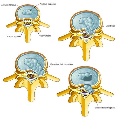 Stages of Disc Herniation Disc Herniation, Lumbar Disc, Spinal Decompression, Middle Back Pain, Disk Herniation, Bulging Disc, Human Body Anatomy, Spine Health, Medical Anatomy