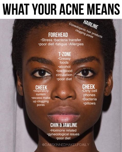 @_okoro • Instagram photos and videos How To Clear Cheek Acne, How To Clear Chin Acne, Bumps On Chin, Chin Breakouts, Jawline Acne, Cheek Acne, Chin Acne, Back Acne Remedies, Acne Tips