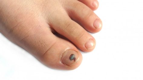 Black Spot On Toenail, Black Toenail Fungus, How To Trim Dogs Toenails, Nail Fungal Infection Toenails, Dog Toenail Injury, Infected Toenail, Black Toe Nails, Toenail Polish, Feet Nails