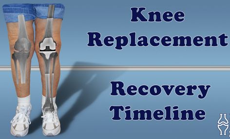 Full Knee Replacement, Knee Replacement Surgery Recovery, Meniscus Surgery, Knee Replacement Exercises, Knee Replacement Recovery, Knee Pain Relief Remedies, Knee Surgery Recovery, Compression Therapy, Swollen Knee