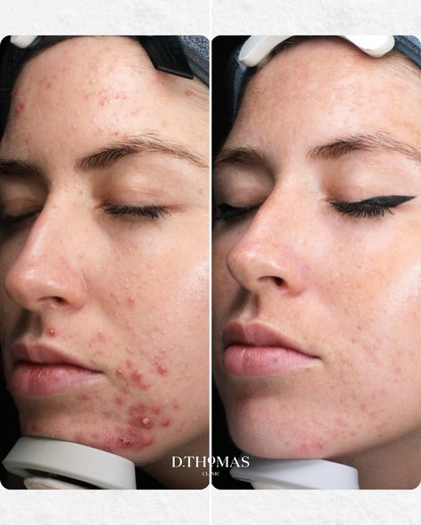 4 months of acne progress 🤍 our client’s skin journey included a combination of our signature laser and non-laser treatments. We are so pleased with these results!! Managing acne means a complete approach—we calm inflammation, control oil, strengthen skin for faster healing and boost the natural bacteria-fighting process to restore clearer, healthier skin.🌤️ #laserskintreatment #acnemanagement #acnebreakouts #acnetreatment #acneprogress #dthomasclinic #debbiethomas Healing Acne, Skin Journey, Healthier Skin, Healing Process, 4 Months, Facial Masks, Natural Skin Care, Healthy Skin, Acne