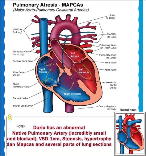 His Rare Case of CHD : Tetralogy of Fallot (ToF) with PA and MAPCAs Tetralogy Of Fallot, Chd Warrior, Anatomy 101, Cardiac Sonography, Atrial Septal Defect, Congenital Heart Defect Awareness, Tricuspid Valve, Heart Diagram, Radiology Student