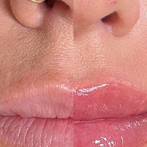 Nika | LA Microblading + Lip Blush Artist on Instagram: "Lip blush side by side - before + right after

Client had pale lips with a lack of definition along her borders. We did a nudey toned pink that will heal about 40% softer than what you see here. Cannot wait to show you all the healed results! 

Booking link in my bio xo

#fluffybrows #naturalmicroblading #microbladingla #microbladinglosangeles #lamicroblading #labrows #losangelesbrows #losangelesmicroblading #naturalfluff #wehobrows #beforevsafter#nanoblading
#transformationtuesday #lacosmetictattoo#manhattanbeach #browsgoals #bizbabe #femaleprenuer #blondebrows#browbabe #browtransformation #naturalbrows #southbaybrows #lowmaintenancelifestyle #wakeupwithoutmakeup #minimalistmicroblading" Pale Lips, Lip Blush, Natural Brows, Transformation Tuesday, Without Makeup, Artist On Instagram, Microblading, Side By Side, Borders