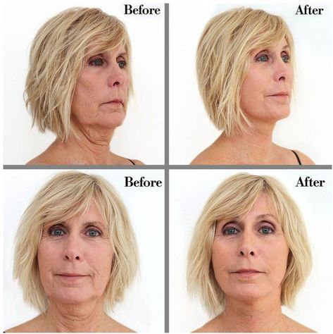 Tighten Your Jawline With Bring It up Instant Neck Lift I - Etsy Haircuts For Fat Faces And Double Chins, Neck Lift Surgery, Face Lift Tape, Neck Tightening, Sagging Neck, Instant Face Lift, Eye Skin Care, Neck Exercises, Celebrity Plastic Surgery