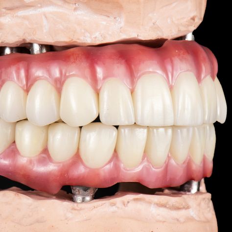 If you are tired of wearing your denture or if your denture is loose and ill-fitting, the All on 4 or Teeth-in-a-Day procedure will help you get rid of your denture and provide you with permanent teeth. If you are about to lose your teeth or have many missing teeth, the full-mouth procedure is your answer. 

Contact ☎️ (858) 481-5210
#SolanaSmiles #SolanaBeachDentist #DentalImplants #AllOn4 #ImplantSupportedDentures Missing Teeth, Solana Beach, Dental Implants, Losing You