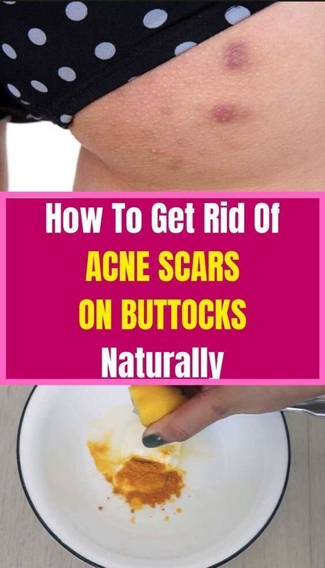 How To Get Rid Of Acne Scars On Buttocks Naturally Buttocks Acne, Get Rid Of Acne, Rid Of Acne, Natural Sleep Remedies, Natural Health Care, Parts Of The Body, Health Vitamins, Reduce Body Fat, Healthy Lifestyle Changes