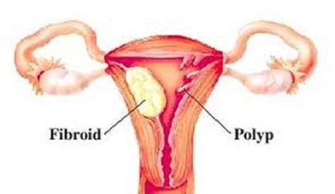 Polyps Uterus, Uterine Polyps, Low Oxalate Diet, Female Fertility, Medical Dental, Feminine Health, Reproductive System, Reproductive Health, Natural Treatments