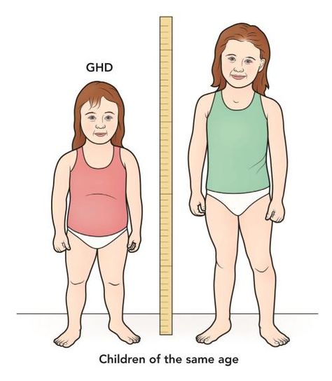 Most children with growth hormone deficiency grow less than 2 inches per year, but in this case the child on the left is much shorter than a child of the same age Pituitary Gland Tumor, Hormone Supplements, Deficiency Symptoms, Pituitary Gland, Bone Strength, Prevent Aging, Growth Factor, Healthy Eating For Kids, Hormone Health