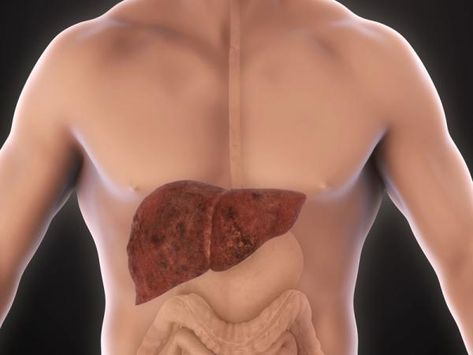 Home Remedies for an Enlarged Liver. An enlarged liver, or hepatomegaly, is a condition that presents with very few symptoms during the initial stage of inflammation. This makes the tas... Quadrants Of The Abdomen, Enlarged Liver, Liver Recipes, Serious Illness, Body Organs, Toning Workouts, Loose Skin, Veggie Recipes, Home Remedies