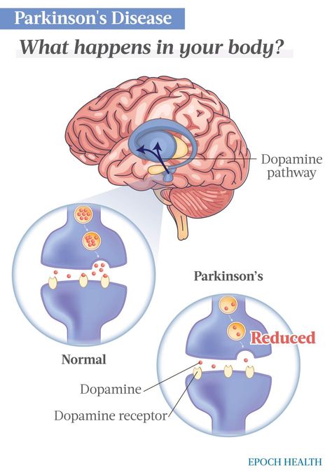 The Essential Guide to Parkinson’s Disease: Symptoms, Causes, Treatments, and Natural Remedies | The Epoch Times Sugar Control Tips, Parkinson Disease, Gait Training, Lewy Body, Pain Relief Remedies, Personality Psychology, Disease Symptoms, Science Notes, Joints Pain Relief