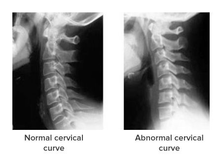 Neck Vertebrae, Upper Cervical Chiropractic, Whiplash Injury, Chiropractic Quotes, Cervical Vertebrae, Types Of Surgery, Neck Exercises, Spine Health, Vagus Nerve