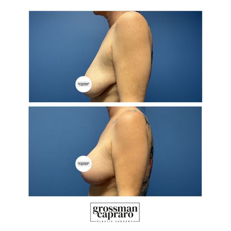 Check out these results from the mastopexy master himself, @dr.philippeacapraro 🤩 While the scars look similar, breast lifts and breast reductions have two different goals. Reductions are meant to reduce tissue whereas lifts keep all tissue and remove only excess skin!⁠ ⁠ #GrossmanCapraroPlasticSurgery #breastlift #mastopexy #breastprocedures #breastsurgery #beforeandafter #plasticsurgerybeforeandafter #denvermom #denverwomen #denverplasticsurgery #denver Different Goals, Excess Skin, Breast Reduction, Breast Surgery, Breast Lift, Plastic Surgery, Denver, Skin