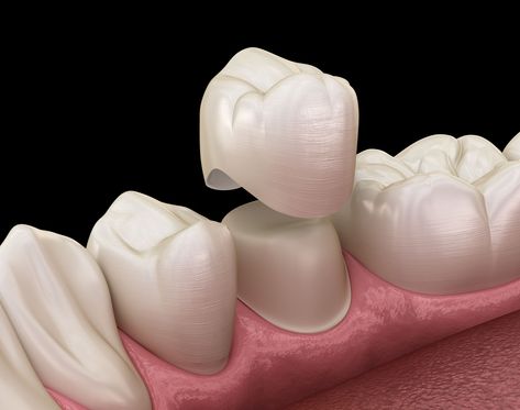 Dental Crown Procedure, Porcelain Crowns, Tooth Crown, Dental Restoration, Kedokteran Gigi, Dental Fillings, Restorative Dentistry, Emergency Dentist, Dental Bridge