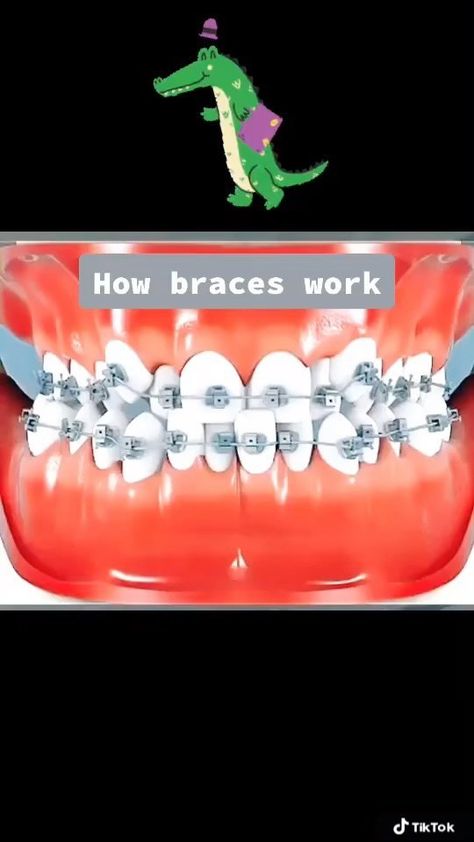 drsuliman_orthodontist on Instagram: Magical Smile Transformation: Formula for success is universal. It applies to every aspect of your life including your braces journey! This… Braces Journey, Braces Transformation, Smile Transformation, Braces, Tik Tok, How To Apply, On Instagram, Instagram