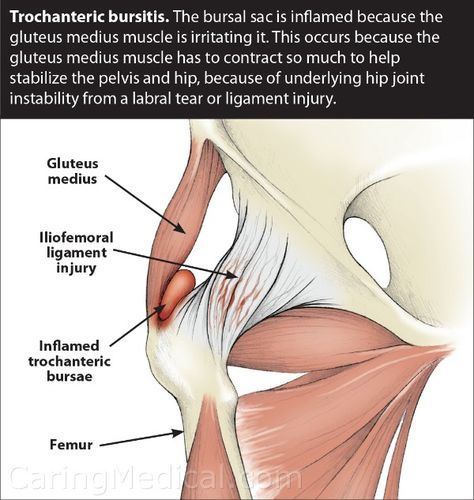 Femoroacetabular Impingement, Greater Trochanteric Pain Syndrome, Snapping Hip Syndrome, Hip Impingement, Hip Injury, Psoas Release, Bursitis Hip, Hip Fracture, Hip Problems