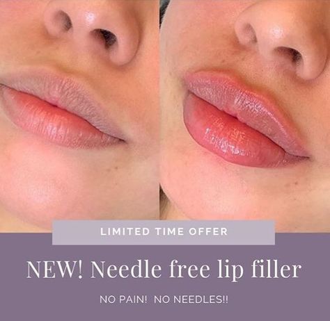 Needle Less Lip Filler, Needleless Lip Filler, Lip Threading Before And After, Hyaluron Lip Filler, Lip Filler Shape Ideas, Lip Fillers Juvederm, Needle Injection, Lip Threading, Dermal Fillers Lips