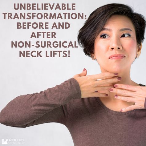 Neck Lift Naturally, Neck Lift Before And After, Neck Lift Surgery, Skin Tightening Procedures, Neck Tightening, Sagging Neck, Laser Lipo, Excess Skin, Neck Wrinkles