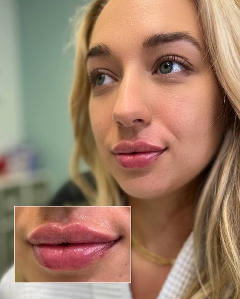 THESE LIPS ARE TO DIE FOR! 🫦 We just leveled up this pout game with a sharp Cupid's bow and the perfect touch of volume🥂 Your lips, but make them fabulous 😉 Ready to embrace your new lip goals? ✨ Come see what we can do for your smile 👨🏻‍⚕️ @seanmoore_toscamoore 👨🏻‍⚕️ @dr.getsnatched 👩🏻‍⚕️ @toxtorri 👩🏻‍⚕️ @bodyglowbodysculpting 👩🏽‍⚕️ @elevated_beautybysamiah 👩🏿‍⚕️ @tylatheesty 👩🏼‍⚕️ @colbytheaesthetician ____________________ BOOK WITH US ⬇ 🌐 Online Booking -link in bio 📲 (386) 438-868... Lip Goals, Cupid's Bow, Cupids Bow, Beauty Goals, Lip Fillers, Med Spa, Your Lips, Your Smile, Come And See