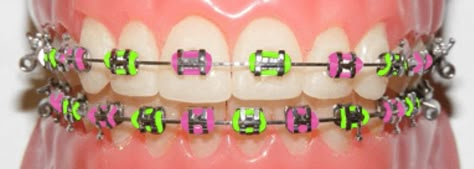 Black Braces Teeth, Teeth Gens, Different Types Of Braces, Braces Transformation, Pink Braces, Braces Colors Ideas, Braces Ideas, Black Braces, Braces Cost