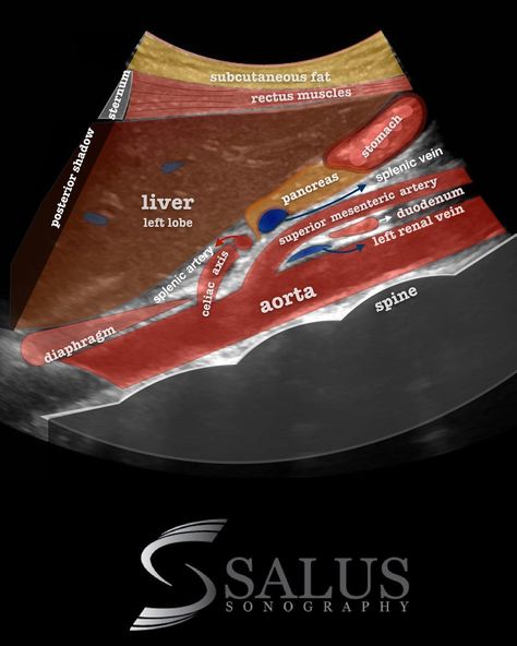 Diagnostic Medical Sonography Student, Ultrasound School, Ultrasound Physics, Cardiac Sonography, Vascular Ultrasound, Abdominal Aorta, Sonography Student, Medical Sonography, Ultrasound Sonography