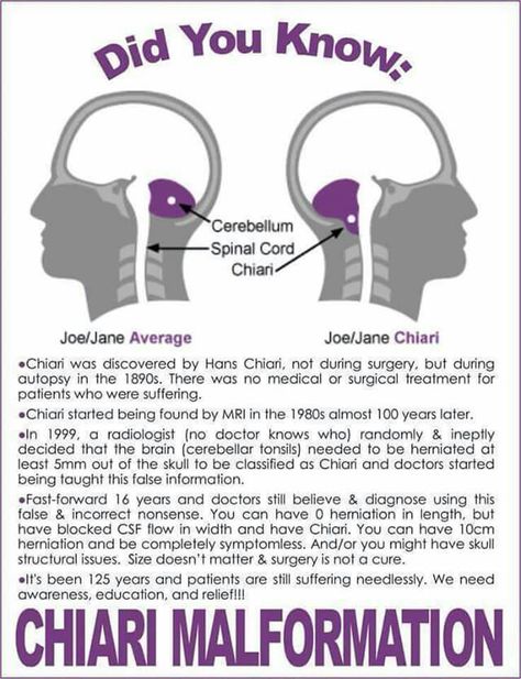 Chiari Malformation Awareness, Autonomic Nervous System Dysfunction, Chiari Malformation, Autonomic Nervous System, Ehlers Danlos Syndrome, Invisible Illness, Functional Medicine, Anatomy And Physiology, Neck Pain