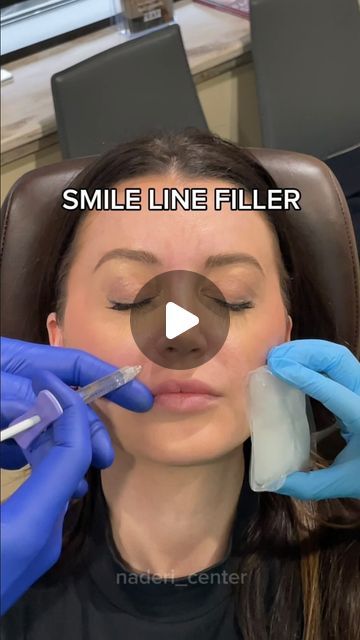 Shervin Naderi on Instagram How To Inject Lip Filler, Where To Inject Lip Filler, Nasolabial Folds Filler, Nasal Labial Folds Filler, Laugh Lines Filler Before And After, Nasal Fold Filler Before And After, Lip Injections Before And After 0.5ml, Filler Before And After Face, Nasal Labial Folds Before And After