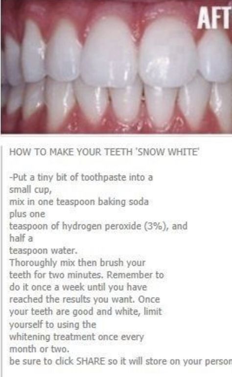 Whiten Teeth At Home, Natural Teeth Whitening Remedies, Teeth Whitening Methods, Teeth Whitening Homemade, Teeth Whitening Remedies, Teeth Whitening Diy, Cleaning Advice, Whiten Teeth, Tooth Sensitivity