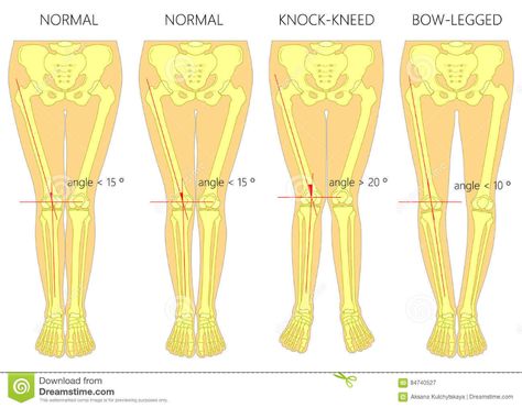 Knock Knees Correction, Genu Valgum, Genu Varum, Bow Legged Correction, Bone Infection, Knock Knees, Bow Legged, Lower Limb, Perfect Legs