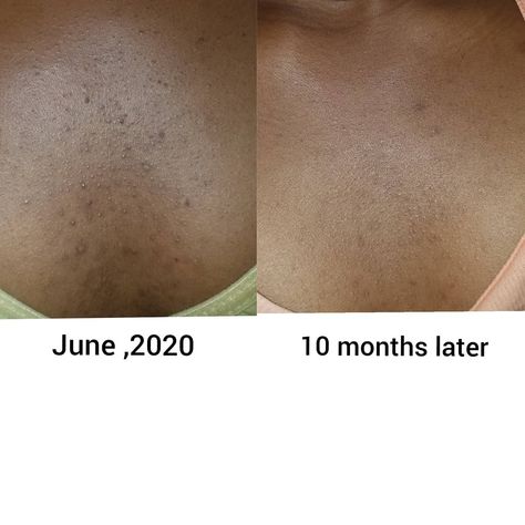 Natural products take time. The progress was slow but goal met. Acne is disappearing 👌 with Unike Naturally body buttter jojoba combination Chest Acne, Natural Products, Take Time, Acne, Skin, Hair