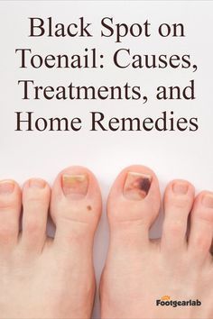 Fungal Nail Remedies Black Spot On Toenail, Black Toenail Fungus, Mass Workout, Toenail Health, Nail Remedies, Antifungal Cream, Toenail Fungus Remedies, Nail Fungus Remedy, Proper Hygiene