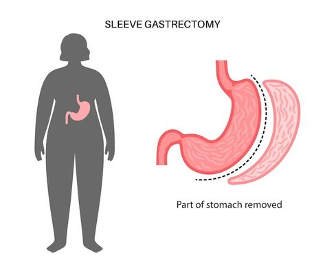 Vertical sleeve gastrectomy laparoscopy ... | Premium Vector #Freepik #vector #gastric-sleeve #gut #bariatric-surgery #digestive-system Vertical Sleeve Gastrectomy, Sleeve Gastrectomy, Sleeve Surgery, Maintain Weight, Medical Tourism, Tummy Tucks, Cardiovascular Disease, Reduce Weight, Surgery