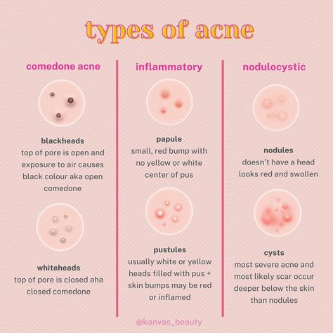 Kanvas Beauty on Instagram: “✿ Know your acne! ✿ You may hear the term “breakout” used to describe all forms of acne, but this isn’t always an accurate description.…” Acne Instagram Post, Blind Pimple, Pimples Under The Skin, Skincare 101, Face Forward, Beauty School, Blackheads, Acne, Product Description