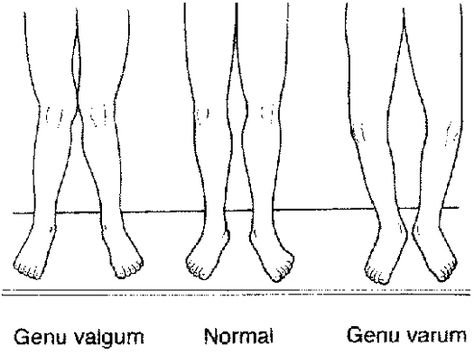 Recently I have been experiencing slight pain after hamstring exercises in the inside of my knees.    Tonight I trained hamstrings and paid close attention to my form to ascertain any potential problems. One thing I noticed is that durring my rack pulls and leg curls my knees (and lower leg) angle inwards. To illustrate, imagine you are standing and doing a quad stretch (bringing your heel to your ass). Instead of my heels each finishing towards the outside of each glute, they travel slightly... Genu Valgum, Genu Varum, Bow Legged Correction, Knock Knees, Hamstring Workout, Bow Legged, Musculoskeletal System, Skeletal Muscle, Body Systems