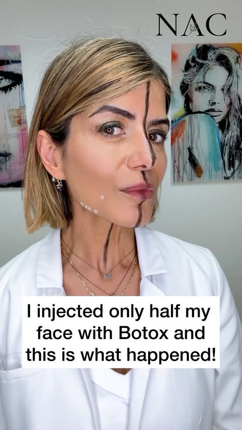 Dr. Bita Zadeh Farrell | #jowls #jowltreatment #drbitafarrell #naturalaestheticscenter | Instagram Botox For Jaw Clenching, Better Than Botox Diy, Soft Lip Filler, Botox Forehead Before After, Filler For Jowls, Platysmal Band Botox Before And After, Botox To Slim Face, Botox Face Lift, Bunny Lines Botox Before And After