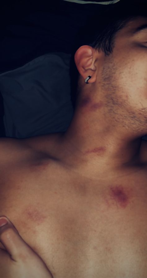 Lovebites Images Couples, Love Bites Hickey For Boys, Love Bites Mark Aesthetic, Neck Bite Boyfriend, Love Bite Snap, Love Bites Hickey, Love Bite Boyfriend, Love Bite Photos, Boyfriend Snap