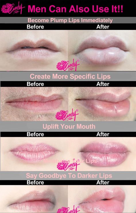 Before and after lip plumper, lip plumper device, CandyLipz lip plumper device #makeup #lips #lipplumper #tutorial #beauty Diy Lip Plumper, Lip Plumper Device, Salt Face Scrub, Face Scrub Recipe, Plumper Lips, Drugstore Lips, Exfoliating Lip Scrub, Lip Scrub Homemade, How To Get Bigger