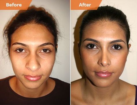 Alar Base Reduction | Nostril Reduction Surgery Botched Rhinoplasty, Nose Goals, Nostril Reduction, Ideal Nose, Plastic Surgery Quotes, Surgery Quotes, Ethnic Rhinoplasty, Bulbous Nose, Dream Face