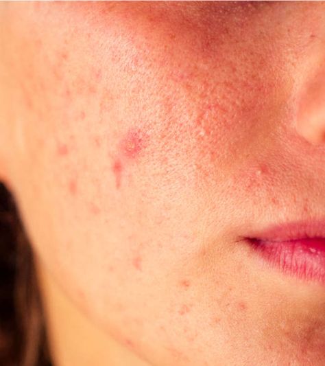 Everything You Need To Know About Acne Papules Papules Acne, Pimple Causes, Blind Pimple, Pimples Under The Skin, Bad Diet, Types Of Acne, How To Get Rid Of Pimples, Daily Yoga, Skin Problems