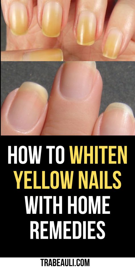 how to whiten yellow nails Stained Nails From Nail Polish, How To Clean Yellow Nails, How To Whiten Toenails, How To Whiten Yellow Nails, How To Whiten Your Nails, How To Get White Nails, Yellow Natural Nails, Lemon Juice Nails, How To Whiten Nails