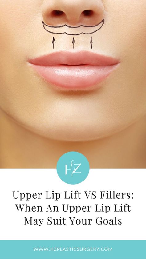 plastic surgery, upper lip lift, upper lip lift vs fillers Lip Lift Surgery Before And After, Lip Threading Before And After, Lip Lift Before And After, Lip Plastic Surgery, Lip Lift Surgery, Upper Lip Lift, Frank Tattoo, Upper Lip Wrinkles, Lip Surgery