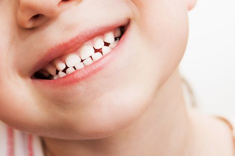 Teeth Grinding & Kids: 5 Reasons Why Your Child May Grind His Teeth! #30secondmom Baby Tooth Chart, Teeth Chart, Dental Bonding, Tooth Chart, Kids Teeth, Pediatric Dentist, Dental Cleaning, Grinding Teeth, Pediatric Dentistry