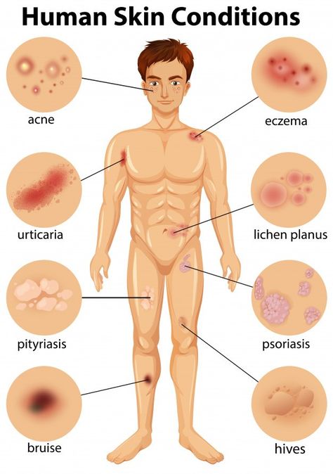 Massage therapists typically see more of a client’s skin than the client does. That fact alone carries with it a responsibility to be educated about some common and not-so-common skin conditions. #knowledge #skinhealth #education https://t.co/XDmJCwbP3A Skin Biology, Adobe Illustrator Portrait, Lichen Planus, Homemade Garden Decorations, Wallpaper Earth, Skin Disorders, Skin Diseases, Quote Backgrounds, Medical Information