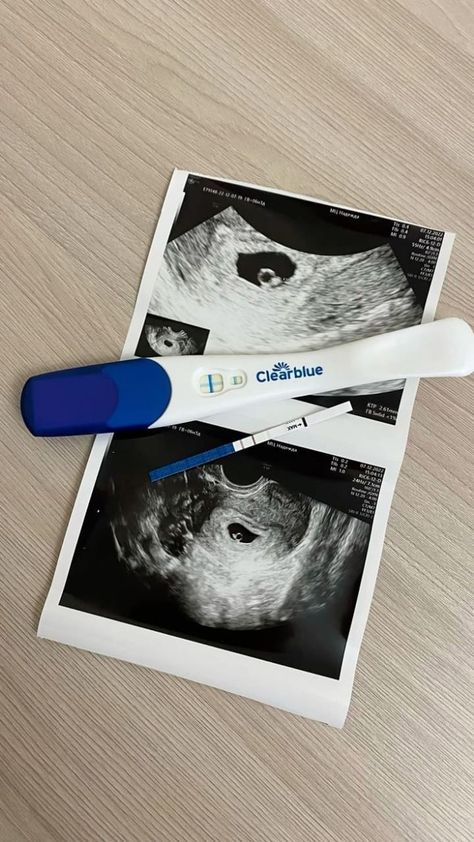 Ultrasound Picture Ideas, Baby Manifestation, Pregnancy Test Announcement, 2024 Baby Announcement, Pregnant Announcement, Announcement Pictures, Cute Pregnancy Pictures, Baby Ultrasound, Cross Pictures