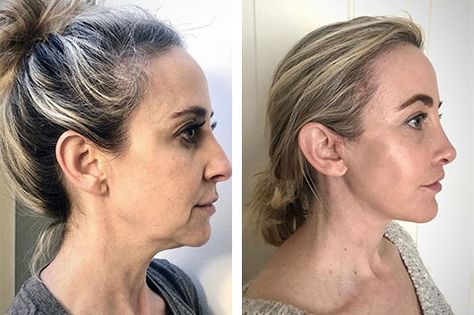 Ponytail Technique Face Lift | New York Ponytail Technique Facelift Ponytail Lift, Deep Plane Facelift, Jaw Reduction Surgery, Mini Face Lift, Facelift Surgery, Facelift Before And After, Facelift Procedure, Facial Aging, Cheek Lift