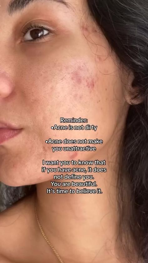 Acne positivity Acne Positivity, Skin Care Hyperpigmentation, Honey For Acne, Face Mapping Acne, Mild Acne, Bad Acne, Acne Treatments, Acne Skincare Routine, Natural Acne Remedies