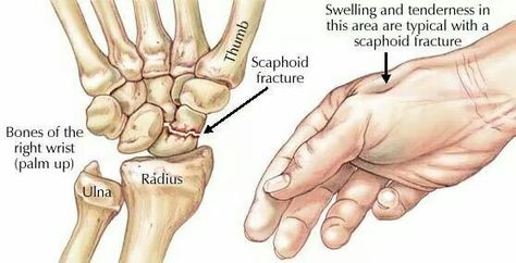 Scaphoid fracture Scaphoid Fracture, Radius And Ulna, Ear Reflexology, Wrist Injury, Bone Fracture, Tight Hip Flexors, Psoas Muscle, Hand Pain, Hand Therapy