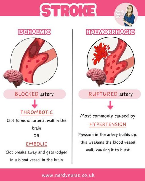 Lauren - Nursing made easy on Instagram: "Ischaemic vs haemorrhagic stroke  A very simple overview  #nursingclinicals #pathophysiologyclass #pathophysiologynotes #nursingstudentsofinstagram #studentnursestudytips #nursingstudentnotes #studentnurses #futurenurses #nursingresources #nurseintraining #nurseinprogress #adultnursing #nursetobe #nursingassociates #traineenursingassociates #traineenursingassociate #studentparamedicuk #studentparamedicsuk #studynursing #studentnurseuk #studentnurse #nursingnotes #nursingschool #nursingstudent #studentnursesofinstagram #studentparamedic #pathophysiology" Romberg Test, Gi Nursing, Nursing Finals, Med Surge, Pathophysiology Nursing, What Is Intelligence, Ulnar Nerve, Nursing School Essential, Student Tips