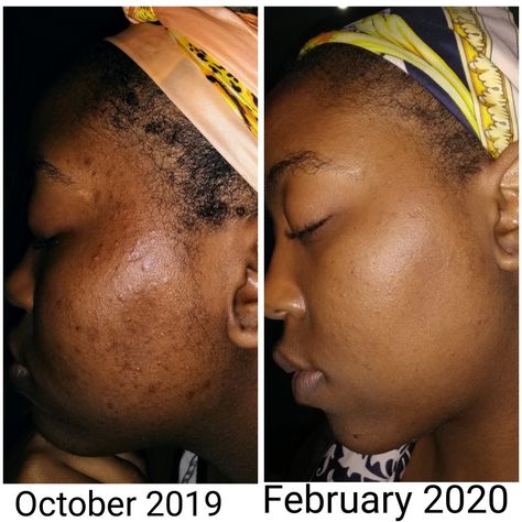 Urban skin rx / before and after photos / review of urban skin rx even tone cleansing bar for dark spots, hyperpigmentation, acne marks and blemishes. Pimples On Scalp, Remove Skin Tags Naturally, Skin Moles, Mole Removal, Skin Tags, Healthy Routine, Acne Remedies, Acne Marks, Glowing Complexion